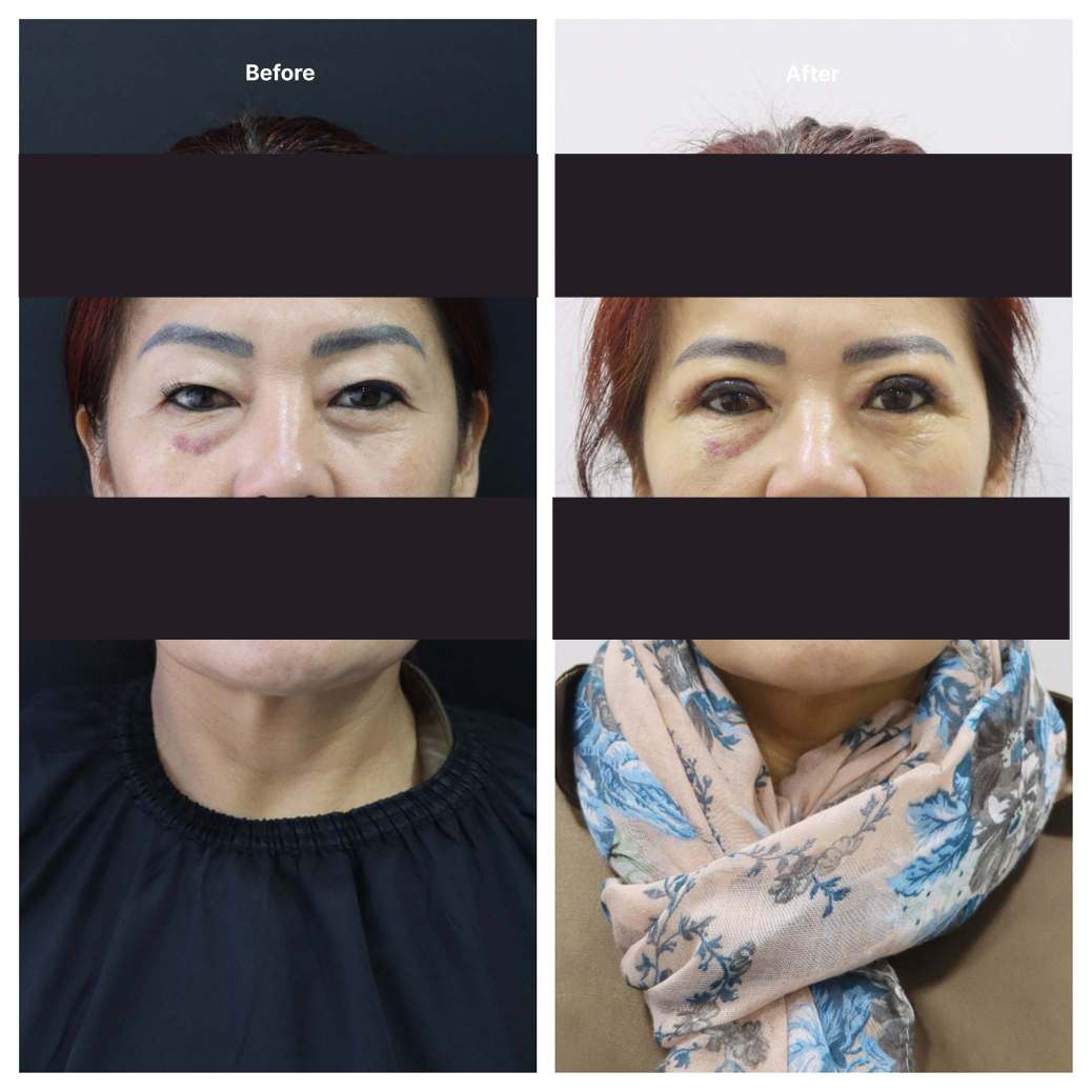 Eyelid Surgery KOQ10